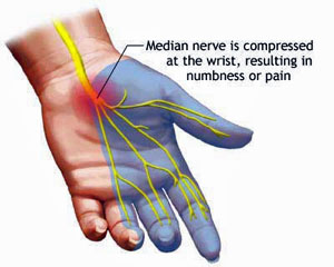 carpal tunnel pain relief